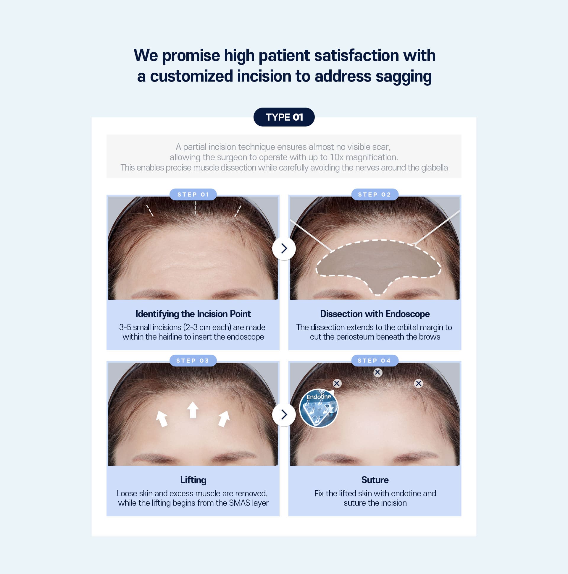 Customized incision surgery Type01