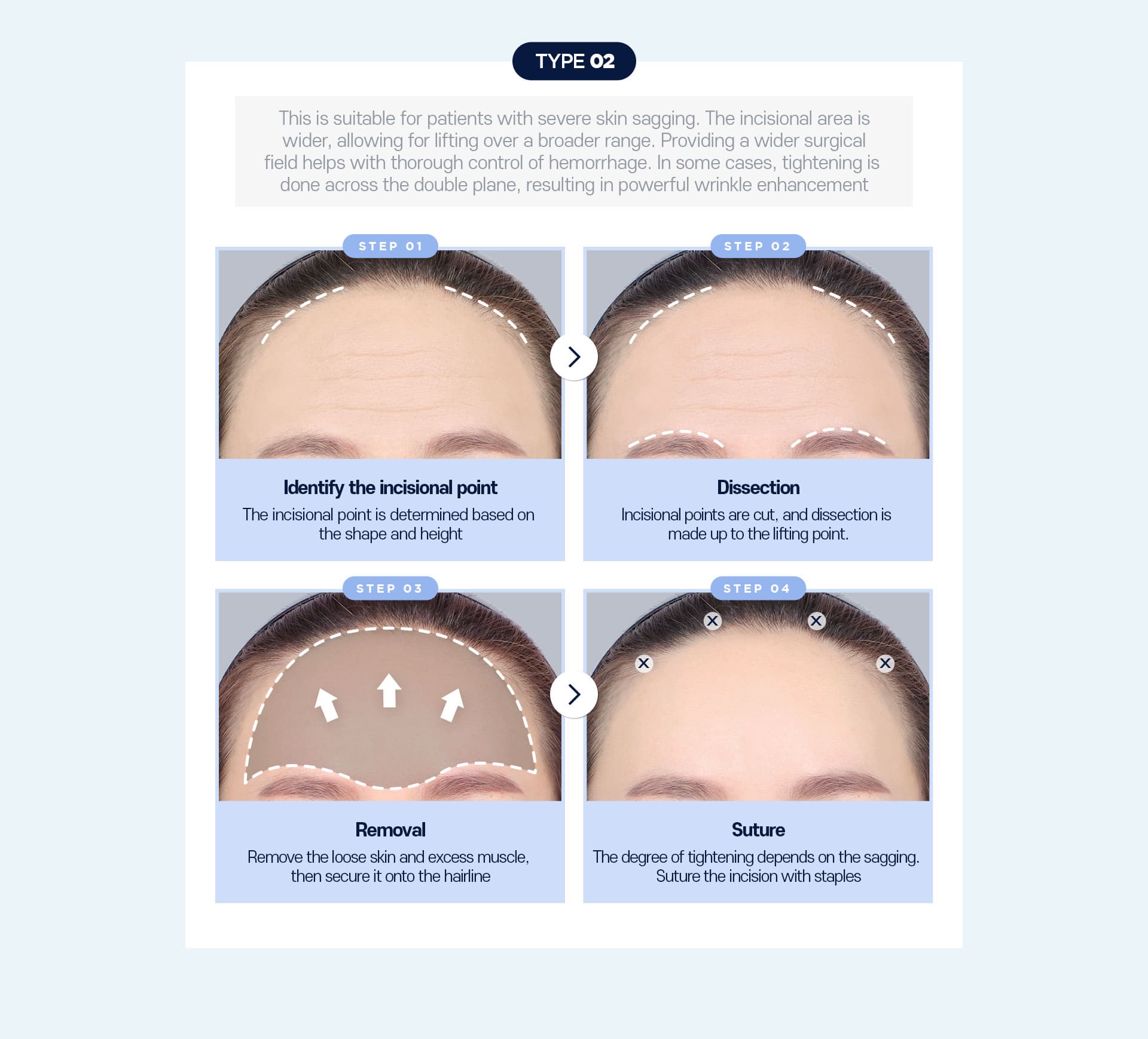 Customized incision surgery Type02