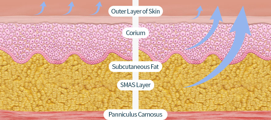 without causing damage to the facial nerve Pulling up to SMAS layer is the key