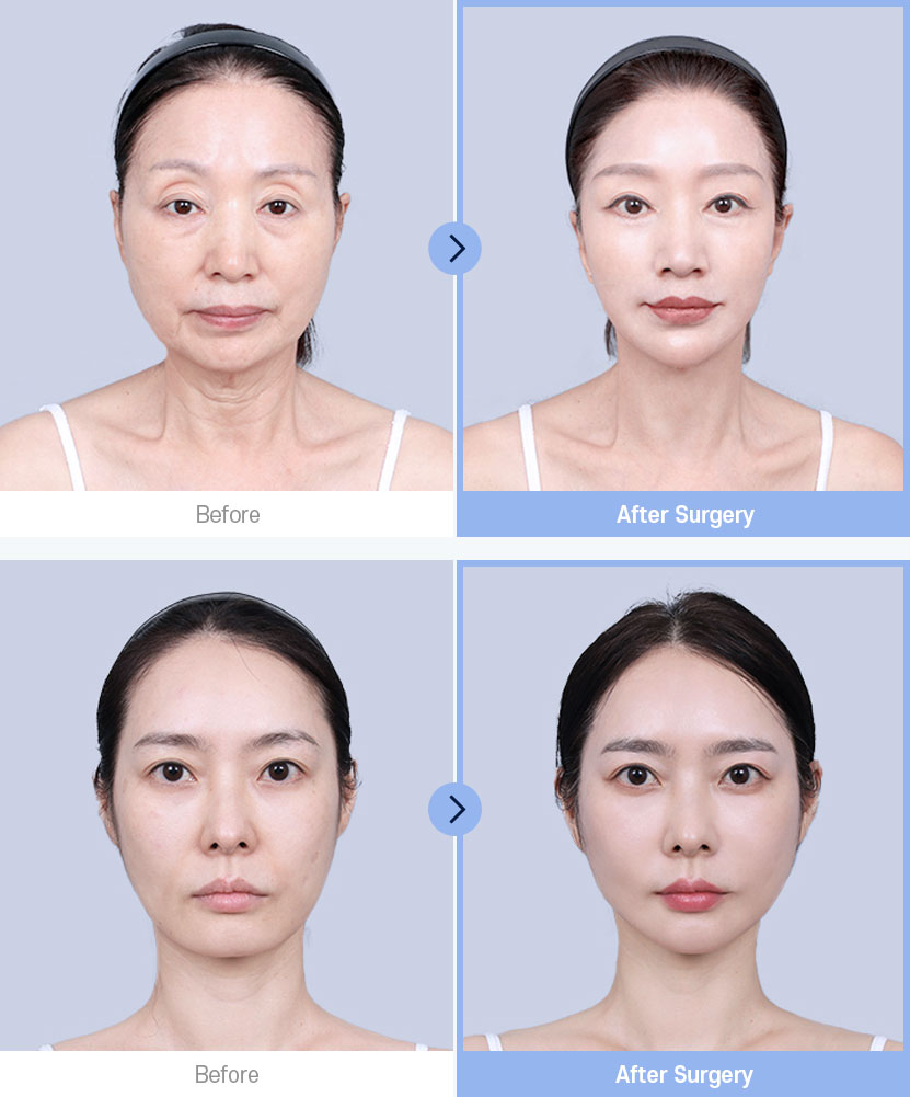 DA Full Face Lifting Before & After Surgery images