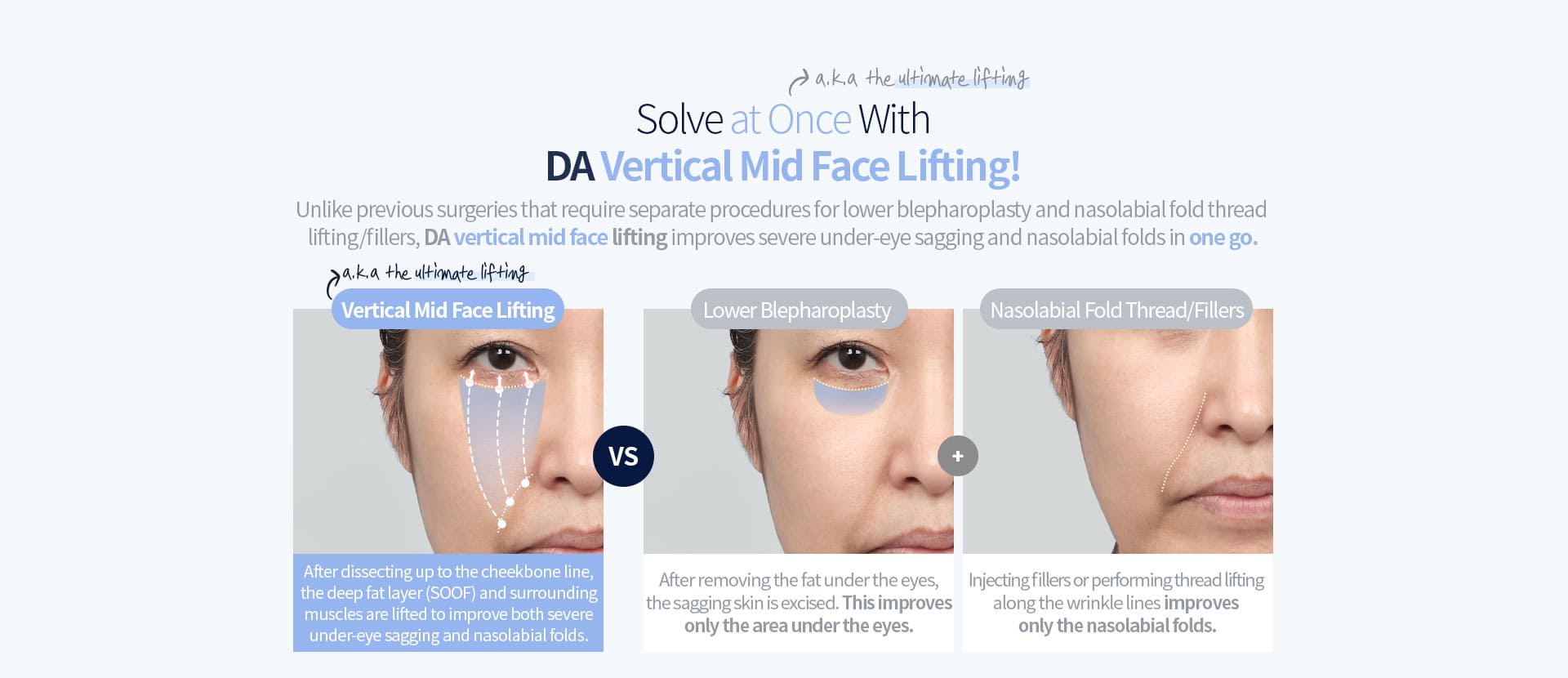 DA Vertical Mid Face Lifting
