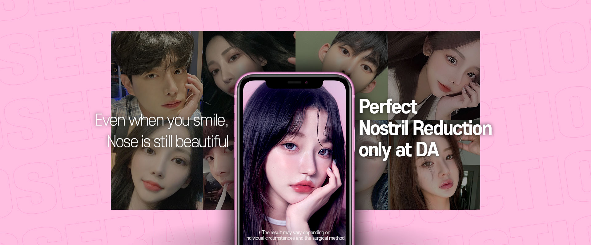 DA Nostril reduction
