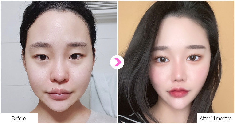 Flat Nose Surgery before&after