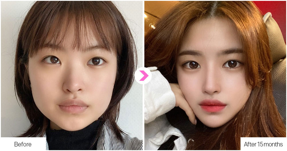 Flat Nose Surgery before&after