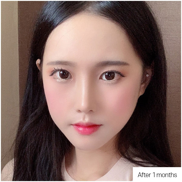Short · Upturned nose correction before&after