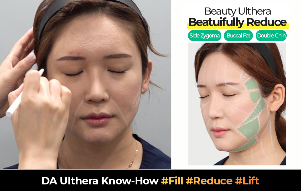 DA ulthera Laser know-how #Fill #Reduce #Lift