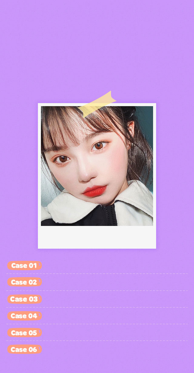 DA Canthoplasty Surgery