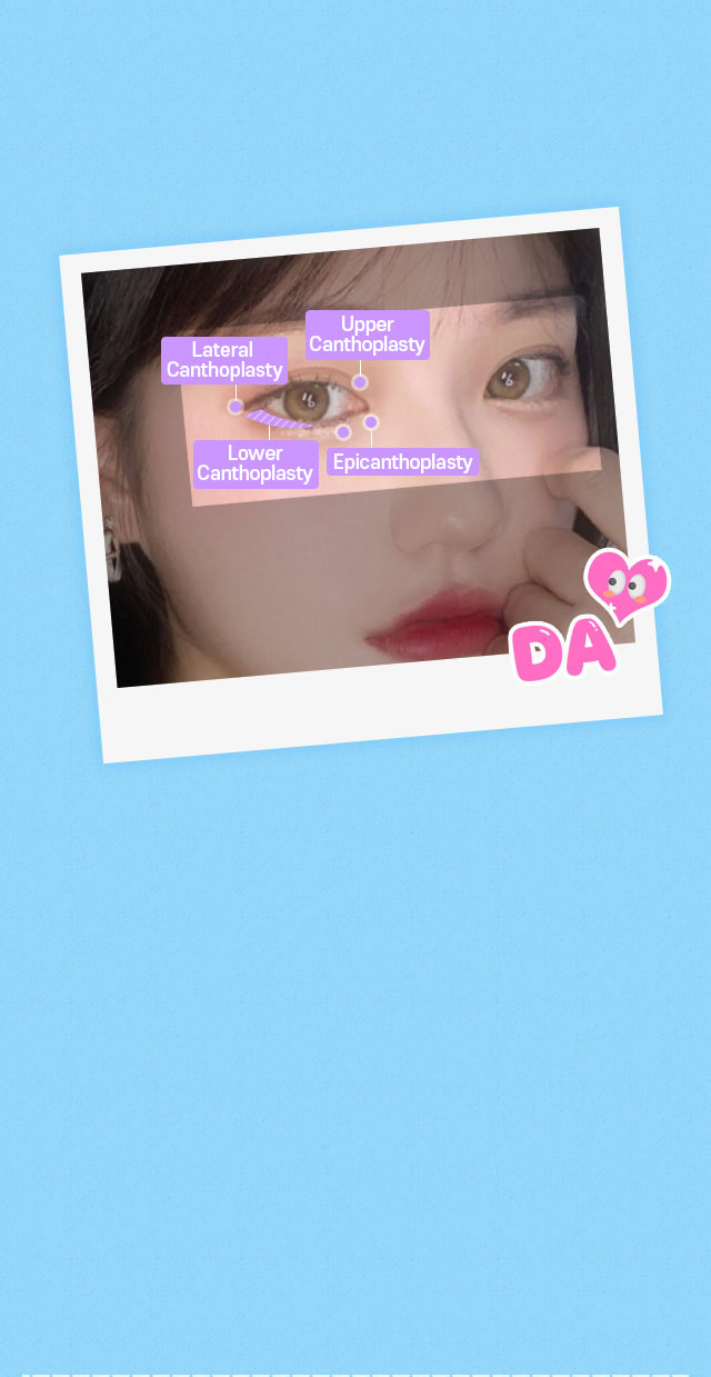 DA Canthoplasty Surgery