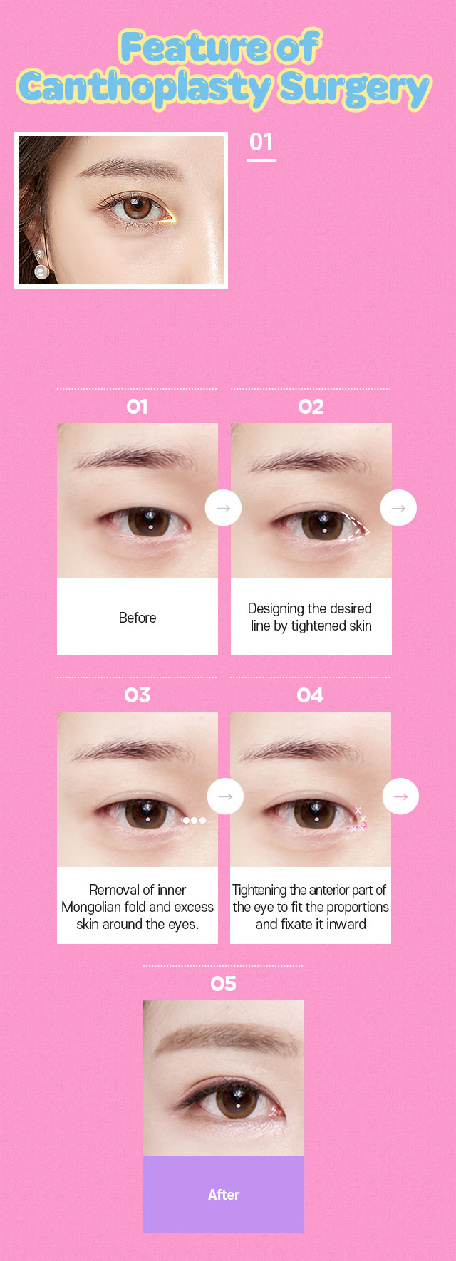 DA Canthoplasty Surgery