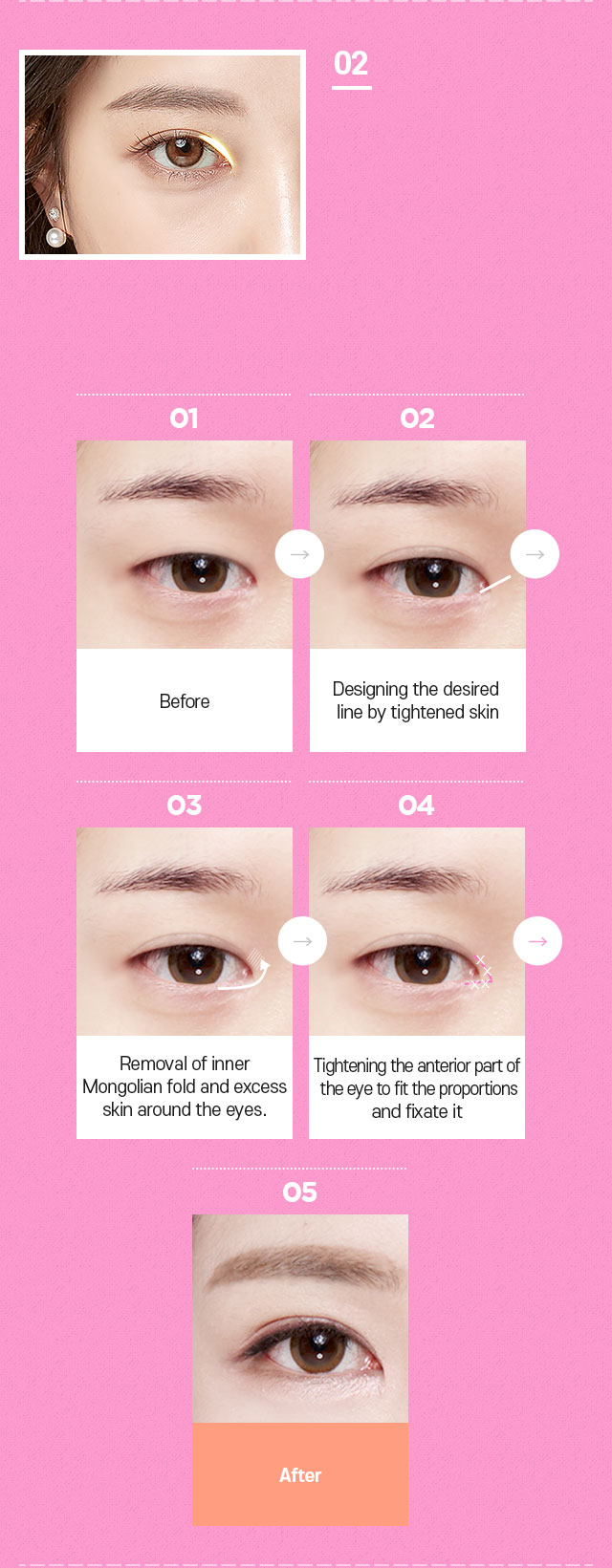 DA Canthoplasty Surgery