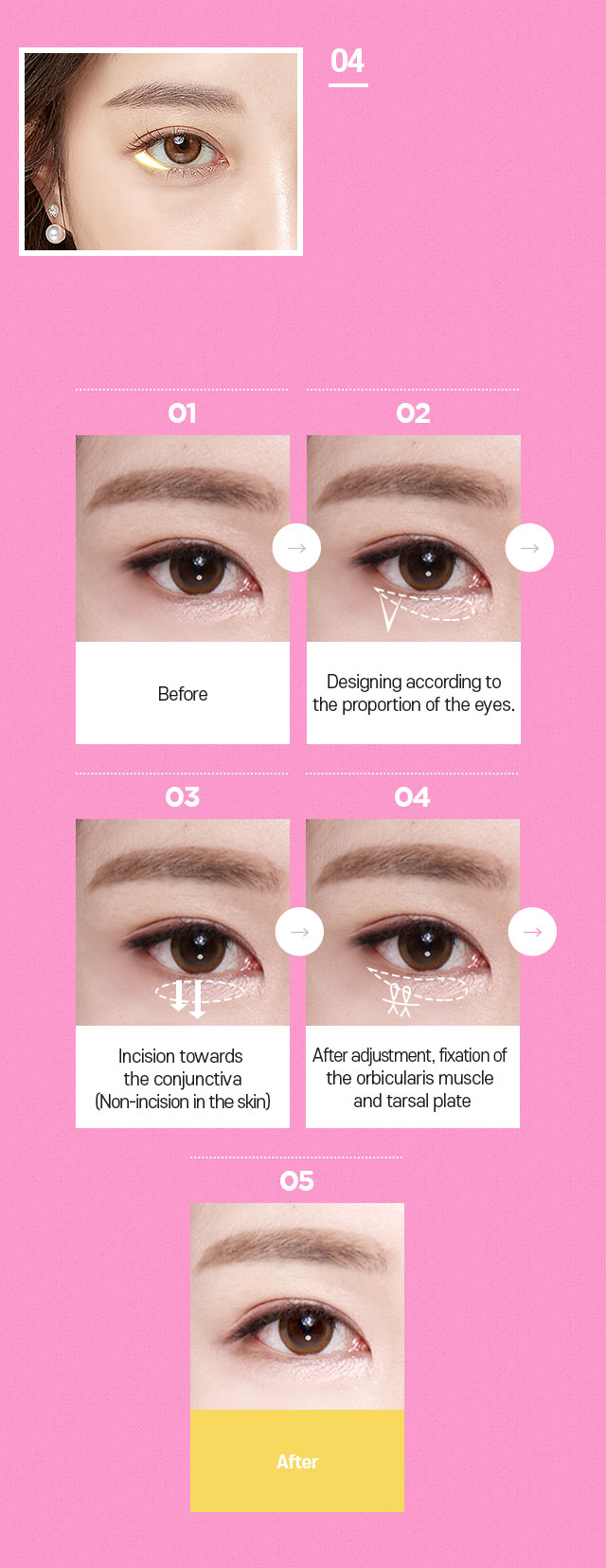 DA Canthoplasty Surgery