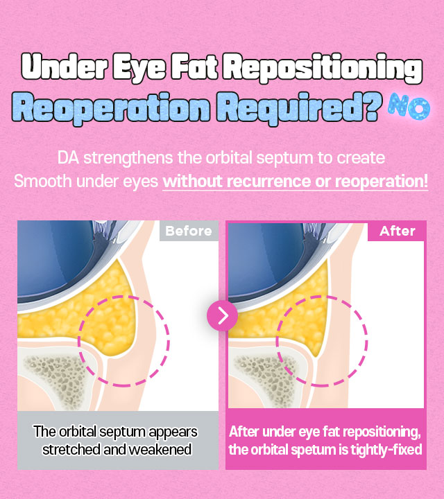 DA Under Eye Fat Repositioning