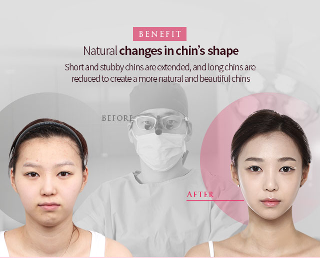 Short and stubby chins are extended, and long chins are reduced to create a more natural and beautiful chins