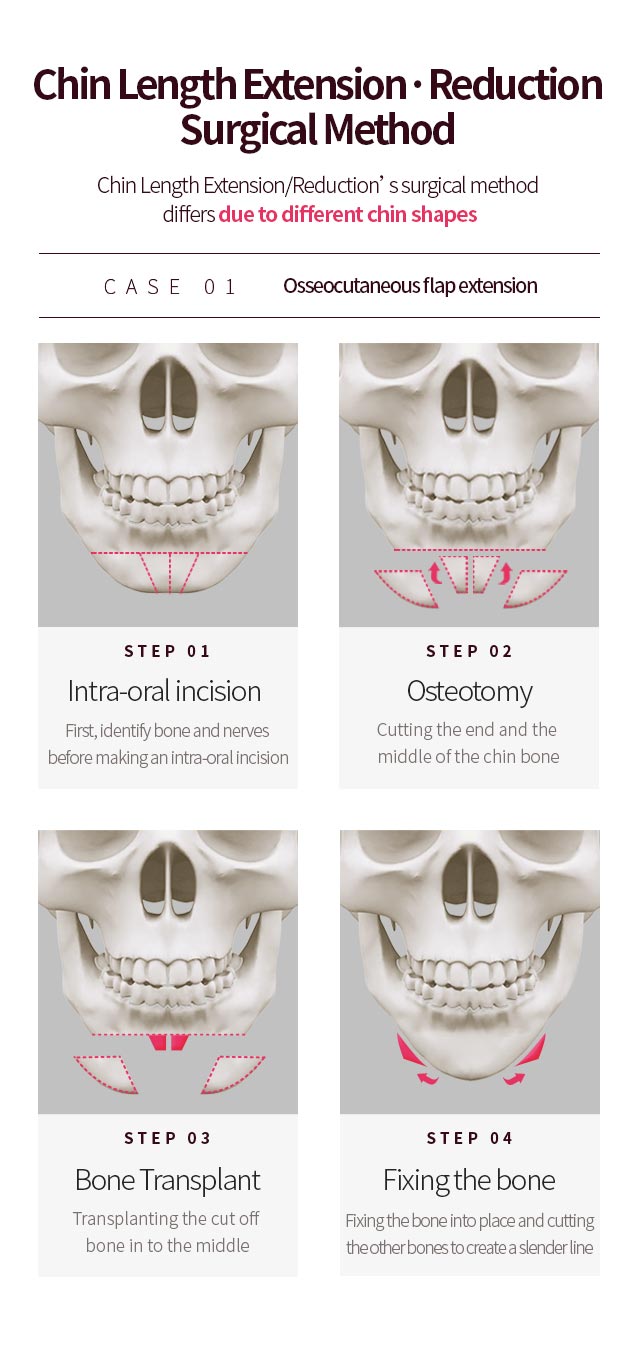 CASE 01. Osseocutaneous flap extension