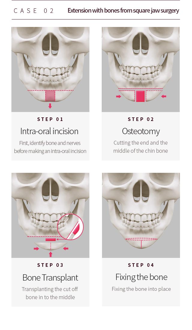 CASE 02. Extension with bones from square jaw surgery