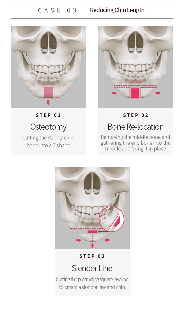 CASE 03. Reducing Chin Length