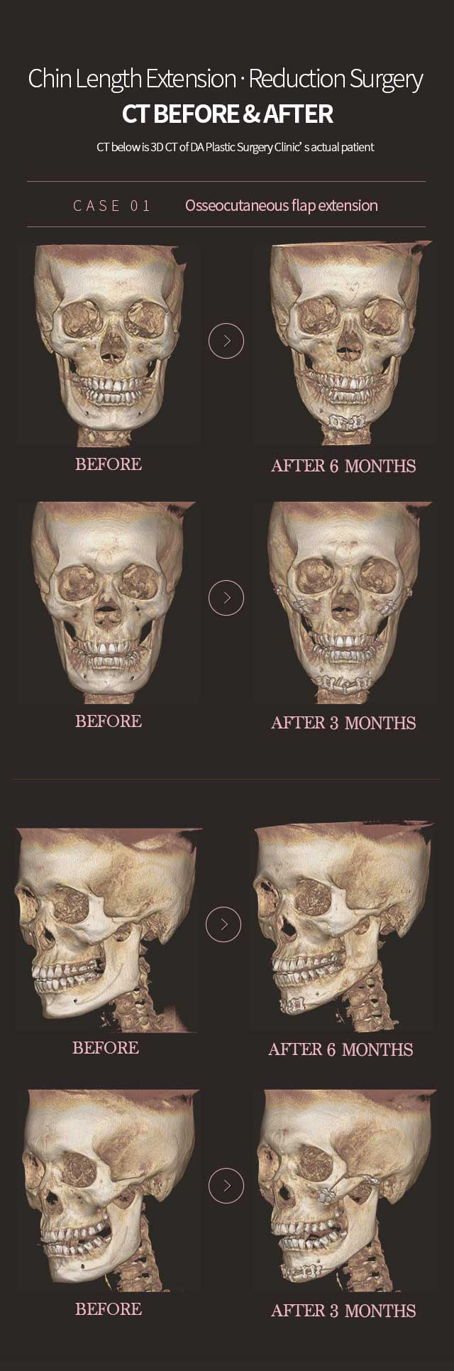 CASE 01. Osseocutaneous flap extension Before & After