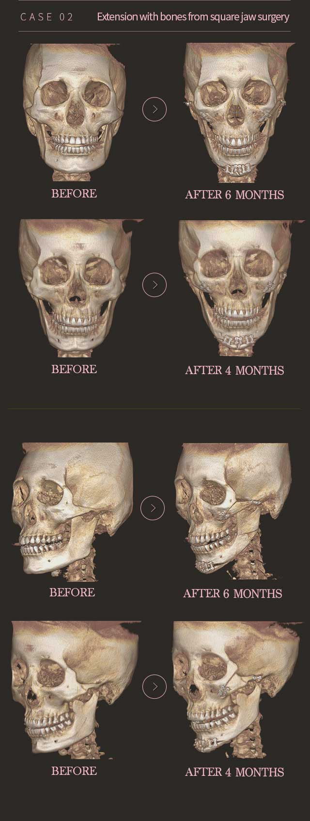 CASE 02. Extension with bones from square jaw surgery Before & After