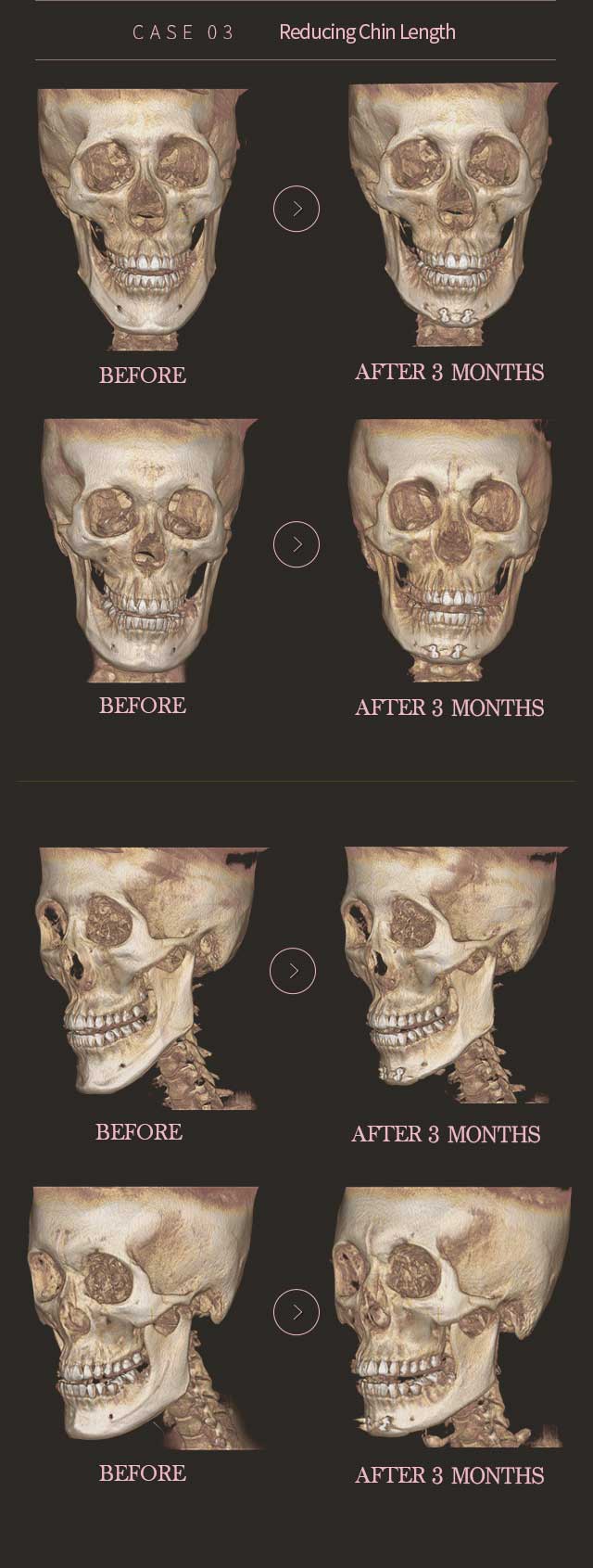 CASE 03. Reducing Chin Length Before & After