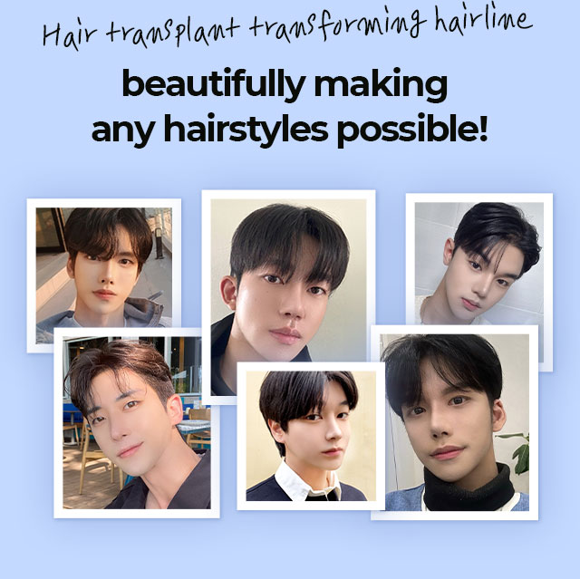 Hair Transplant transforming hairline