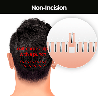 Non-incision