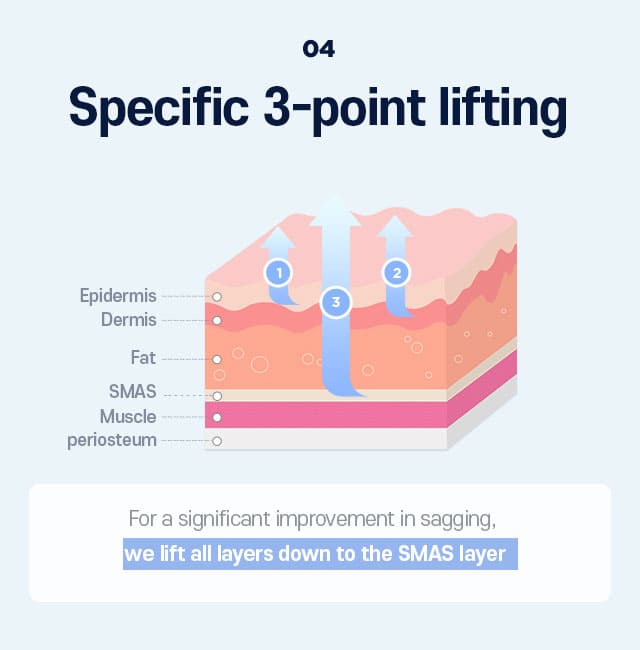 DA Endoscopic Forehead Lift specialty - 04.Specific 3-point lifting
