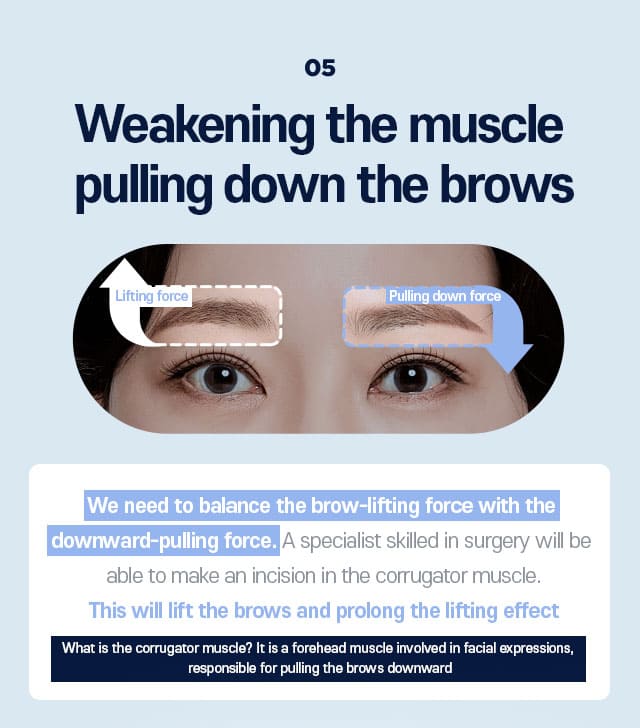 DA Endoscopic Forehead Lift specialty - 05.Weakening the muscle pulling down the brows