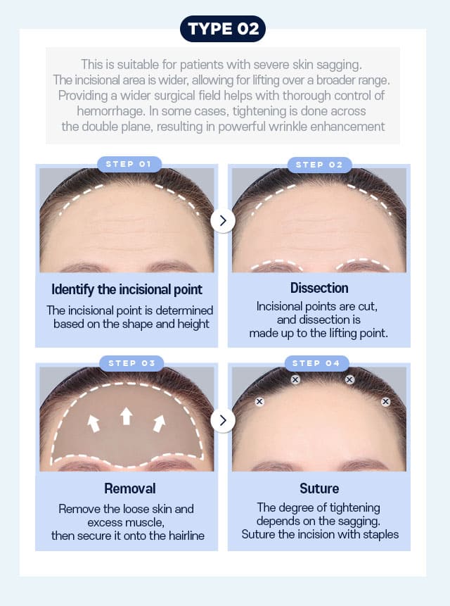 Customized incision surgery Type02