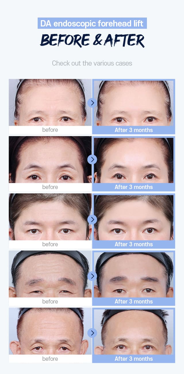 DA Endoscopic Forehead Lift