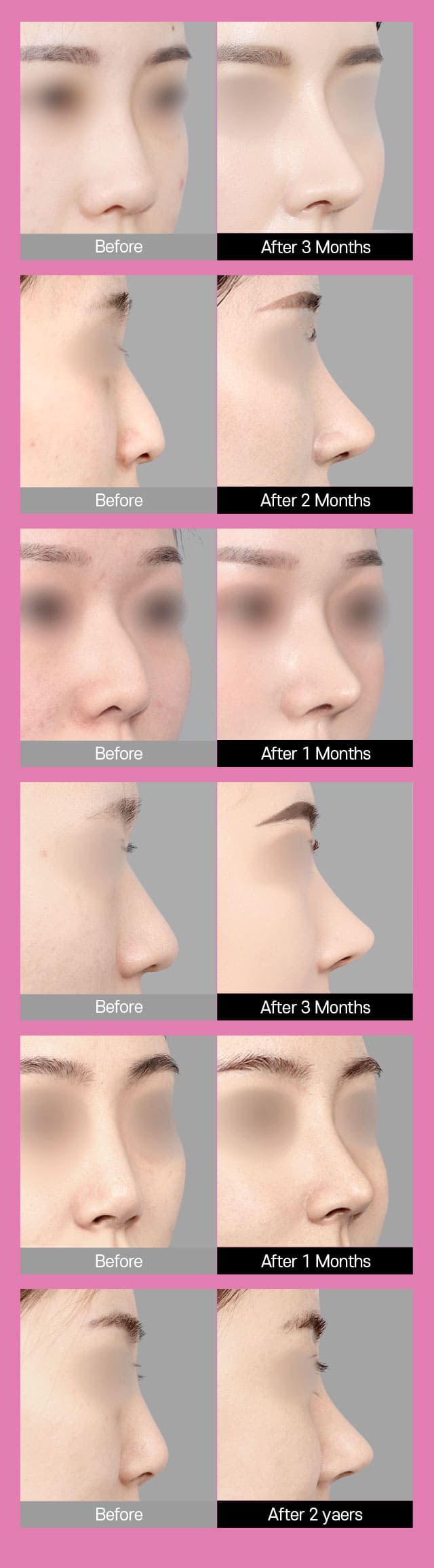 Have Rhinitis, Too? Not sure? Then Check It Out!